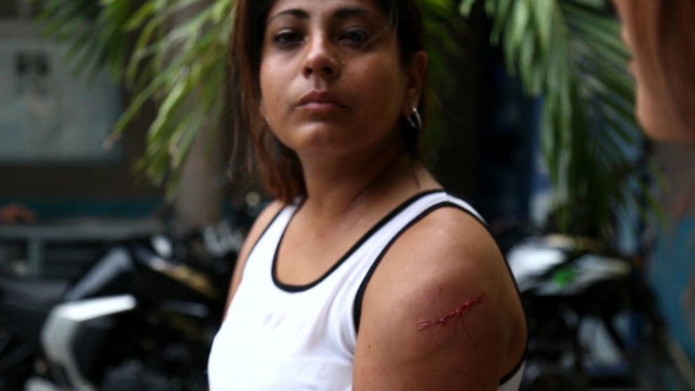 Ligia with a cut on her upper arm